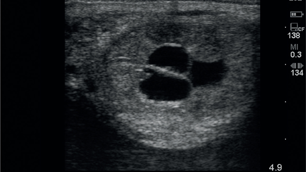 Figure 6. Transrectal ultrasound examination demonstrating three cysts in ‘complex’ in the uterine horn (ultrasound depth 4.9 cm).