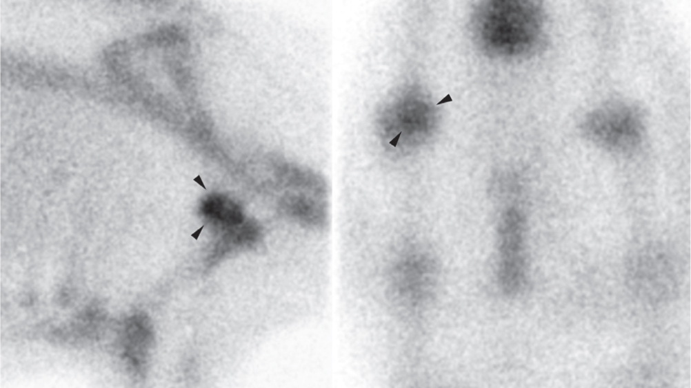 Figure 1. Six-year-old miniature gelding presented for intermittent right forelimb lameness of 6 months duration, negative to distal limb analgesia. There is diffused intense increased radiopharmaceutical uptake involving the caudal aspect of the glenoid and humeral head (arrowheads). Radiology showed fragmentation of the caudal margin of the glenoid and severe periarticular remodelling consistent with osteoarthritis likely secondary to mild joint dysplasia.