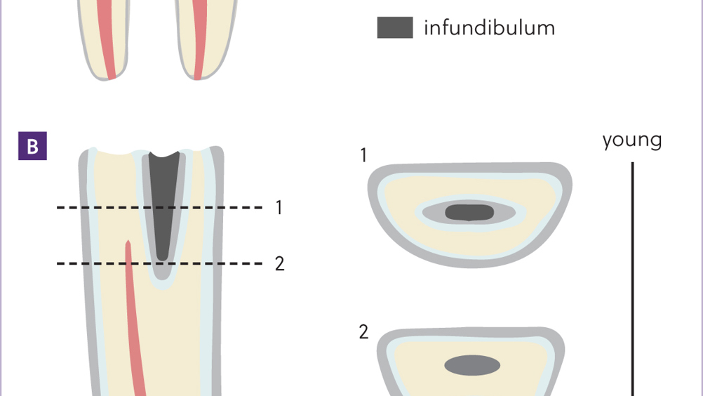 Figure 1. Schematic to show the structural differences between brachydont and hypsodont teeth. a) Brachydont tooth (molar) has a low crown covered with enamel, and cementum is only present below the gumline. b) Hypsodont tooth (incisor) has a long reserve crown and continually erupt with the appearance of the occlusal surface changing as the animal ages.