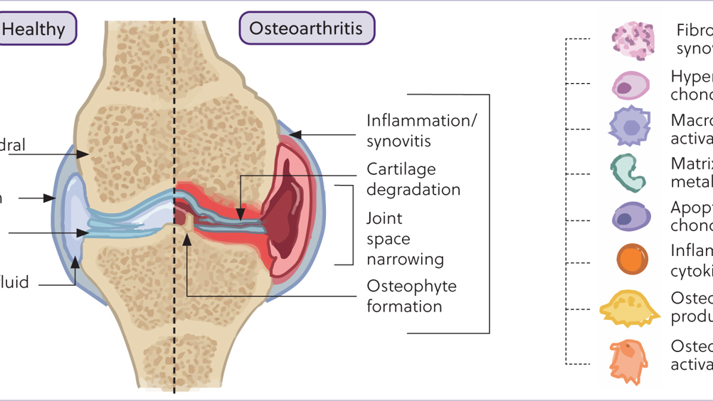 Figure 1. Diagram of the equine metacarpophalangeal joint demonstrating molecular and structural changes found within a healthy joint compared to an osteoarthritic joint.