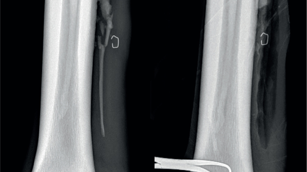 Figure 7. This is the same horse as Figure 5. Radiograph (dorsolateral-palmaromedial oblique) of a comminuted displaced fourth metatarsal fracture (A). The fracture plane and distal fragment were surgically resected (B).